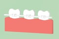 Orthodontic teeth or dental braces