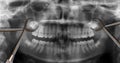 Orthodontic tools and wisdom teeth Royalty Free Stock Photo