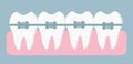 Orthodontic treatment. Braces on your teeth. Concept of dentistry and medicine. Vector illustration in a flat design