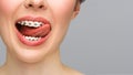 Orthodontic treatment. Closeup ceramic and metal brackets on teeth. Female smile with braces. Dental care concept.