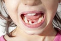 Orthodontic treatment concept image with a small girl showing her mouth. Royalty Free Stock Photo