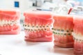 Orthodontics dental braces on teeth model to align teeth Royalty Free Stock Photo