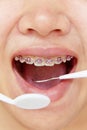 Orthodontics,dental concept