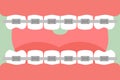 Orthodontics teeth or dental braces, open mouth with healthy teeth and tongue