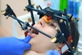 Orthodontist is doing condylography procedure examining mandibular joints. Royalty Free Stock Photo