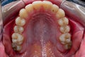 Orthodontist\'s work on a mouth close-up