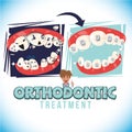 Before and after of orthodontist treatment. come with typographic design - vector illustration