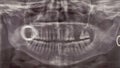 Orthopantomogram. Panoramic dental x-ray of an adult person