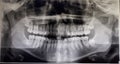 Orthopantomography of an adult patient, dentistry