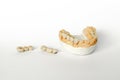 Orthopedic dentistry. tooth replacement concept. dental prosthetics. cermet teeth. ceramic bridges