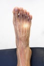 Foot pain in Morton neuroma syndrome with transparent anatomy of nerve.