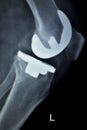 Orthopedic knee implant Xray scan Royalty Free Stock Photo