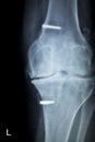 Orthopedic knee implant Xray scan Royalty Free Stock Photo