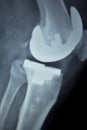 Orthopedic knee implant Xray scan Royalty Free Stock Photo