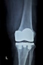 Orthopedic knee implant Xray scan Royalty Free Stock Photo