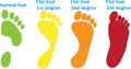 Orthopedic steps of flat foot Royalty Free Stock Photo