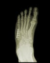 Orthopedic surgery of human foot on x-ray