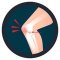 Orthopedics knee icon an injury of ACL or Anterior Cruciate Ligament