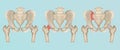 Orthopedics of pelvis and hip fracture