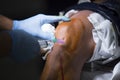 Orthopedics surgery knee arthroscopy anaesthetic Royalty Free Stock Photo