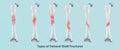 Orthopedics of Types of Femoral Shaft Fractures