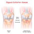 OsgoodÃ¢â¬âSchlatter disease. Healthy Joint and Apophysitis of the tibial tubercle Royalty Free Stock Photo