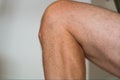 Osgood Schlatters raised tibial tuberosity