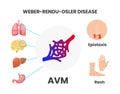 Osler-Rendu-Weber disease signs and symptoms