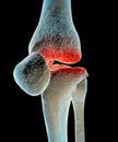 Osteoarthritis