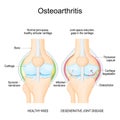 Osteoarthritis. arthritis