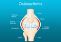 Osteoarthritis. Arthritis of a knee joint