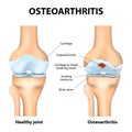 Osteoarthritis or arthritis Royalty Free Stock Photo