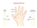 Osteoarthritis. Bones of a human hand