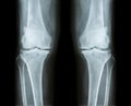 Osteoarthritis both knee . film x-ray AP anterior - posterior of knee show narrow joint space , osteophyte spur , subcond