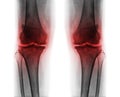 Osteoarthritis both knee .