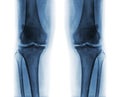 Osteoarthritis both knee .