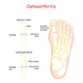 Osteoarthritis. comparison healthy joint and inflammation joint