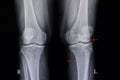 osteoarthritis and cysticcercosis