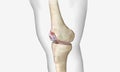 Osteoarthritis is a degenerative form of arthritis that affects articular cartilage Royalty Free Stock Photo