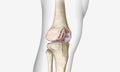 Osteoarthritis is a degenerative form of arthritis that affects articular cartilage Royalty Free Stock Photo