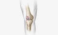 Osteoarthritis is a degenerative form of arthritis that affects articular cartilage