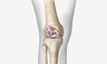 Osteoarthritis is a degenerative form of arthritis that affects articular cartilage Royalty Free Stock Photo