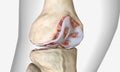 Osteoarthritis is a degenerative form of arthritis that affects articular cartilage