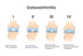 Osteoarthritis four stages anatomical and scientific illustration