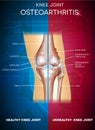 Osteoarthritis