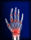 Osteoarthritis image sore inflammation joints of bones the of hand.