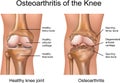 Osteoarthritis of the Knee Royalty Free Stock Photo