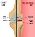 Osteoarthritis Knee Poster Royalty Free Stock Photo