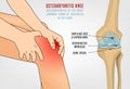 Osteoarthritis Knee Poster