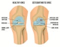 Osteoarthritis Knee Poster Royalty Free Stock Photo